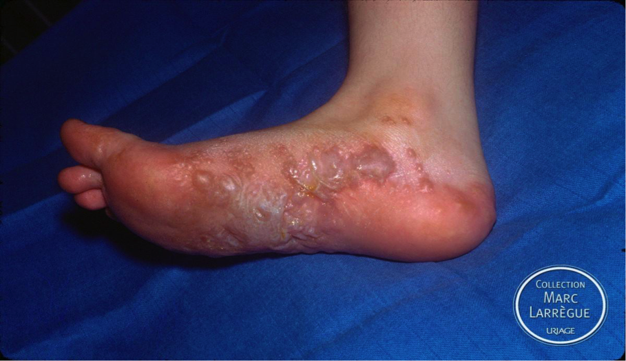Les dermatoses fréquentes aux pieds/ Frequent dermatoses of the ...